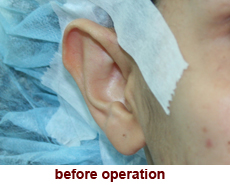 plastic-surgery-prominent-ear 